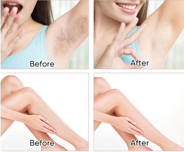 Supreme Kristal Haarverwijderaar™ | 1+1 GRATIS Draagbare haarverwijderaar